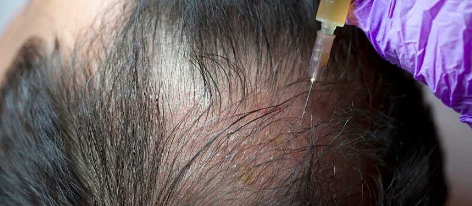 PRP for Hair Loss
